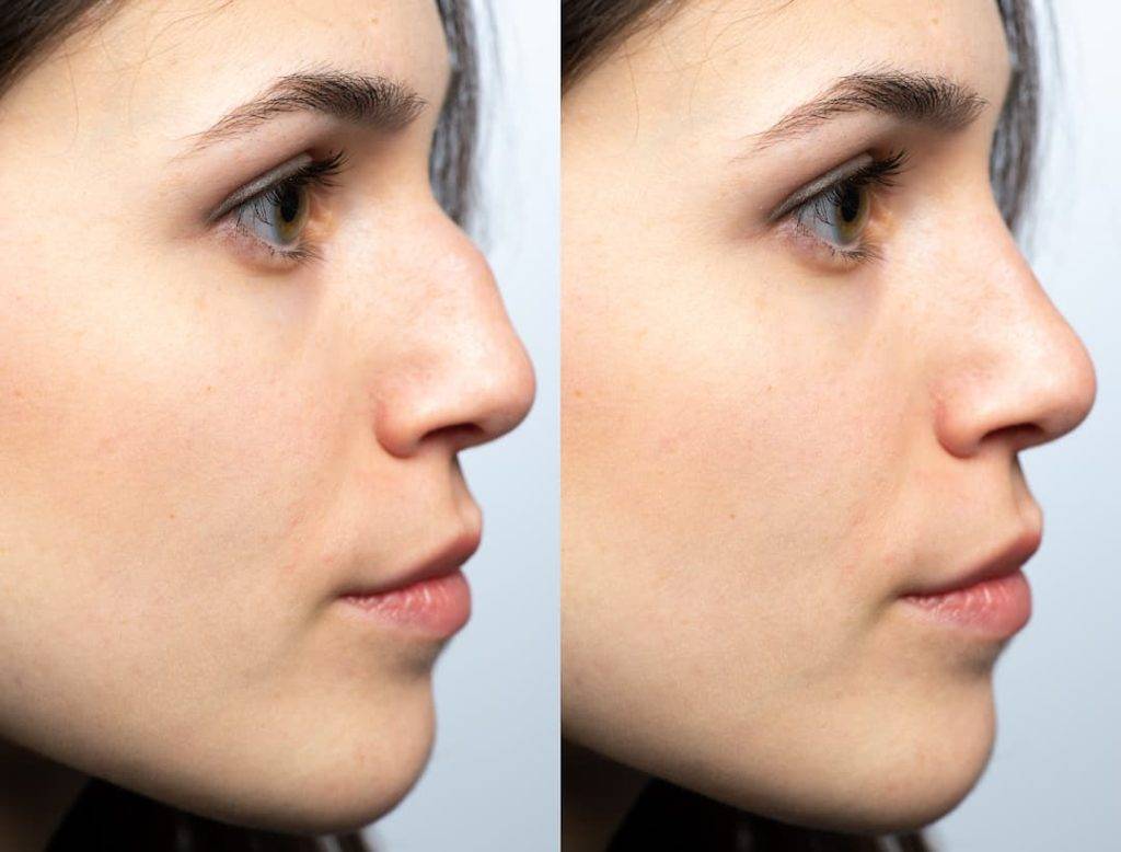 Before And After Of Non Surgical Rhinoplasty Using Filler Injections
