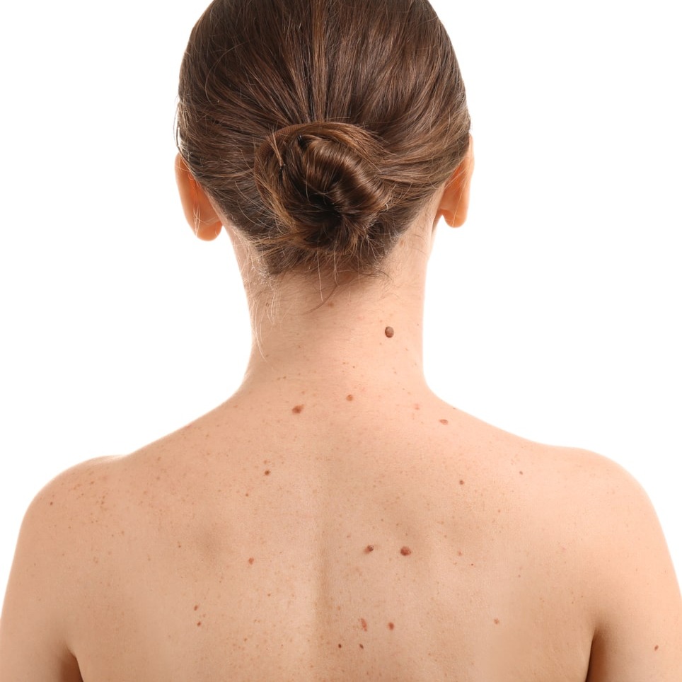 Woman with freckles on back