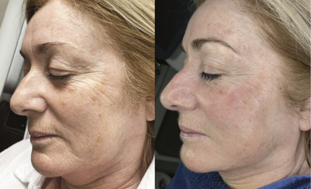 HydrO2 Facial Before & After