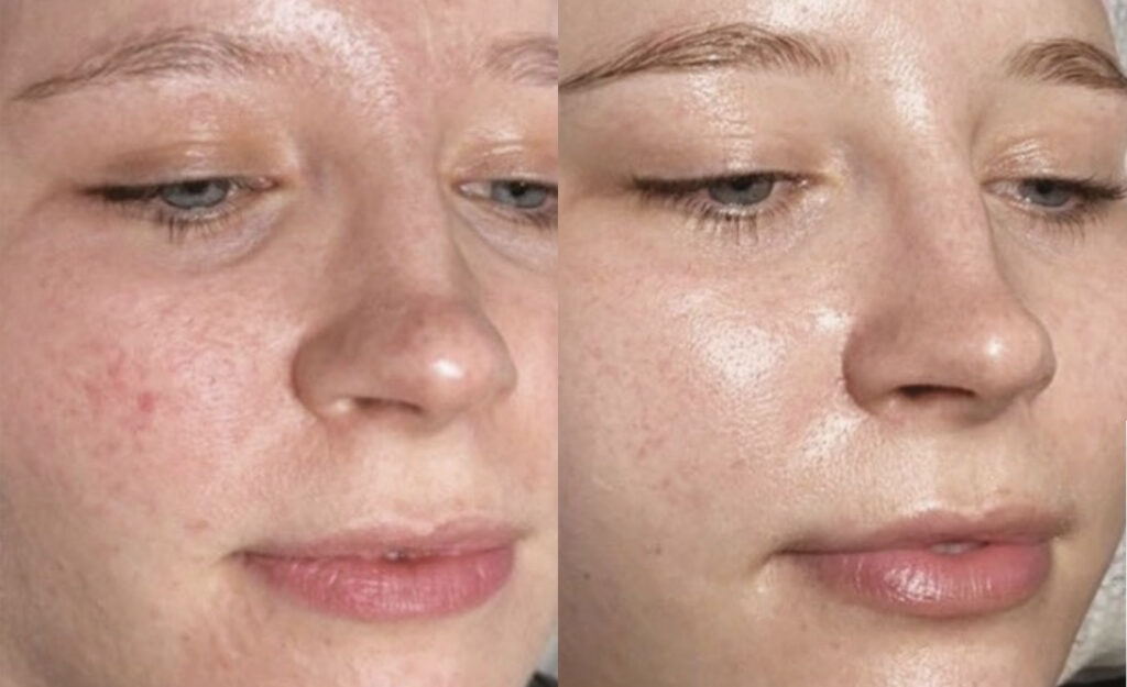 HydrO2 Facial Before & After