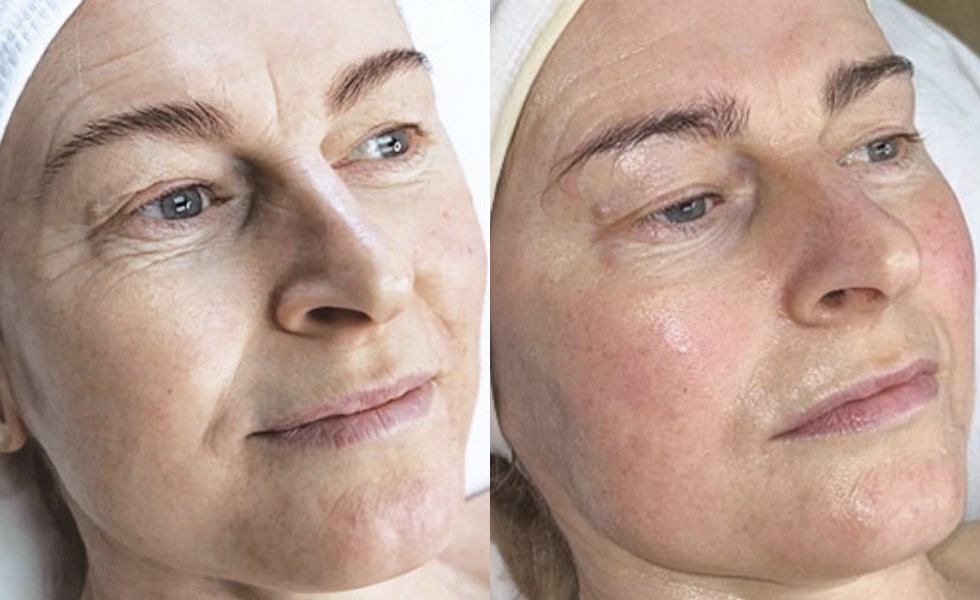 HydrO2 Facial Before & After