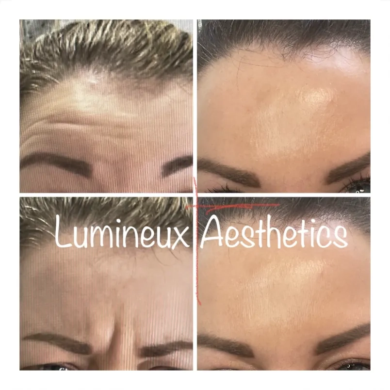 Botox Results