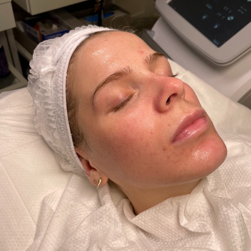 Hydro2 Facial Results