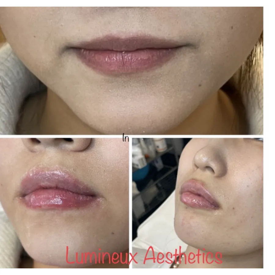 Before & After Lip Filler at Lumineux Aesthetics