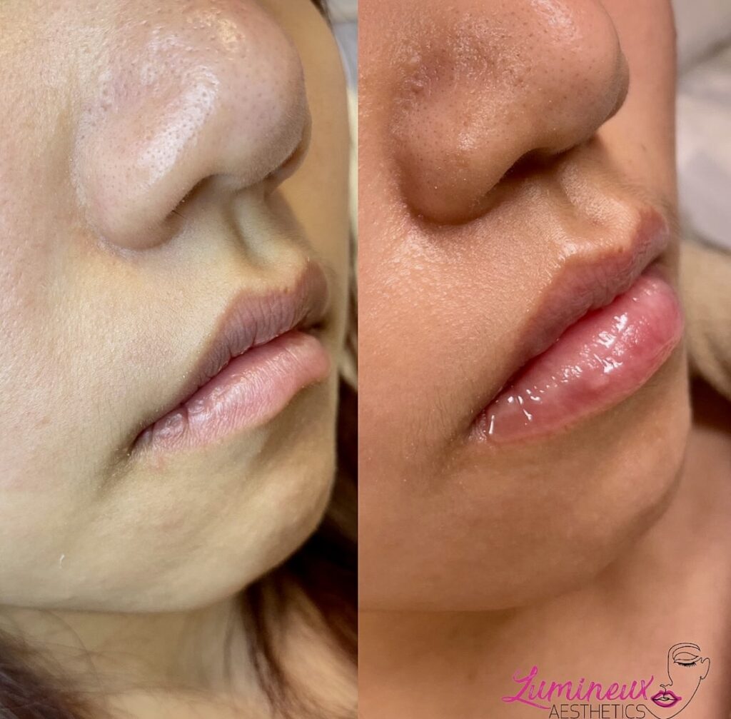 Lip Filler Before & After From Treatment At Lumineux Aesthetics