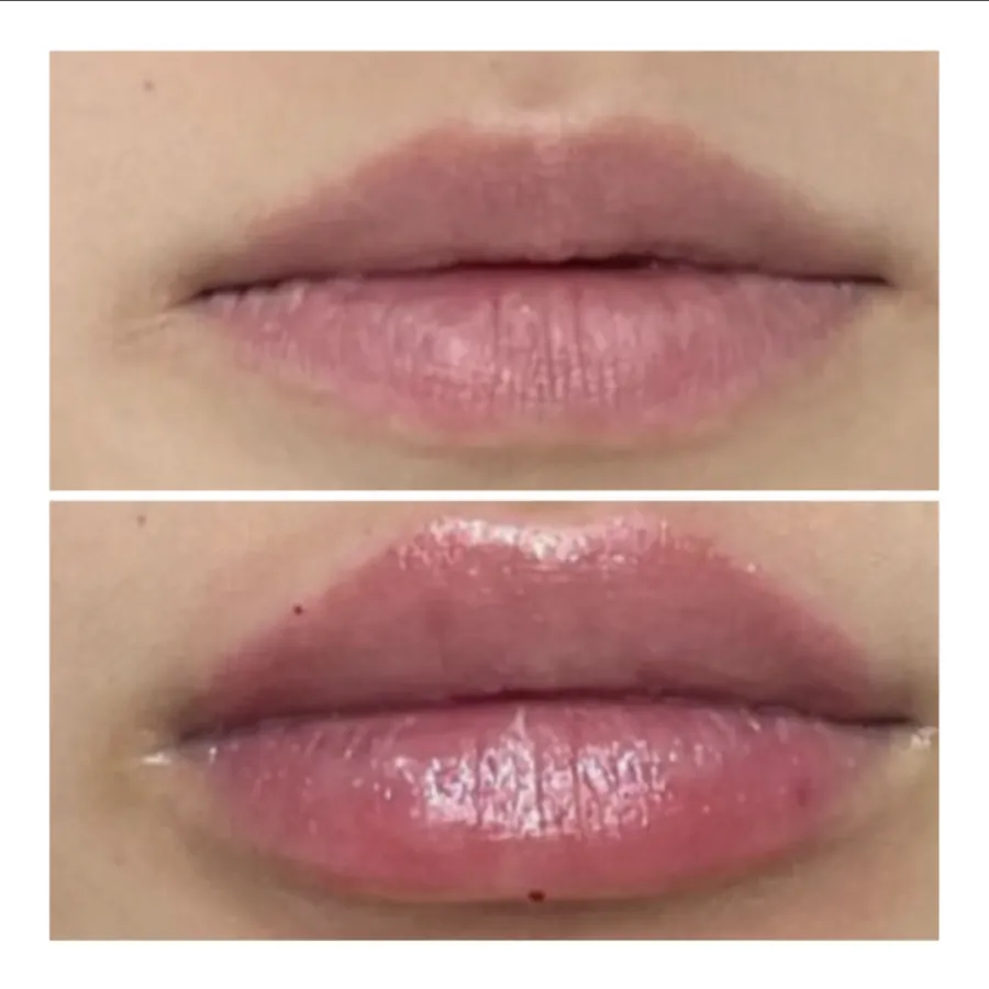 Lip Filler Results at Lumineux Aesthetics