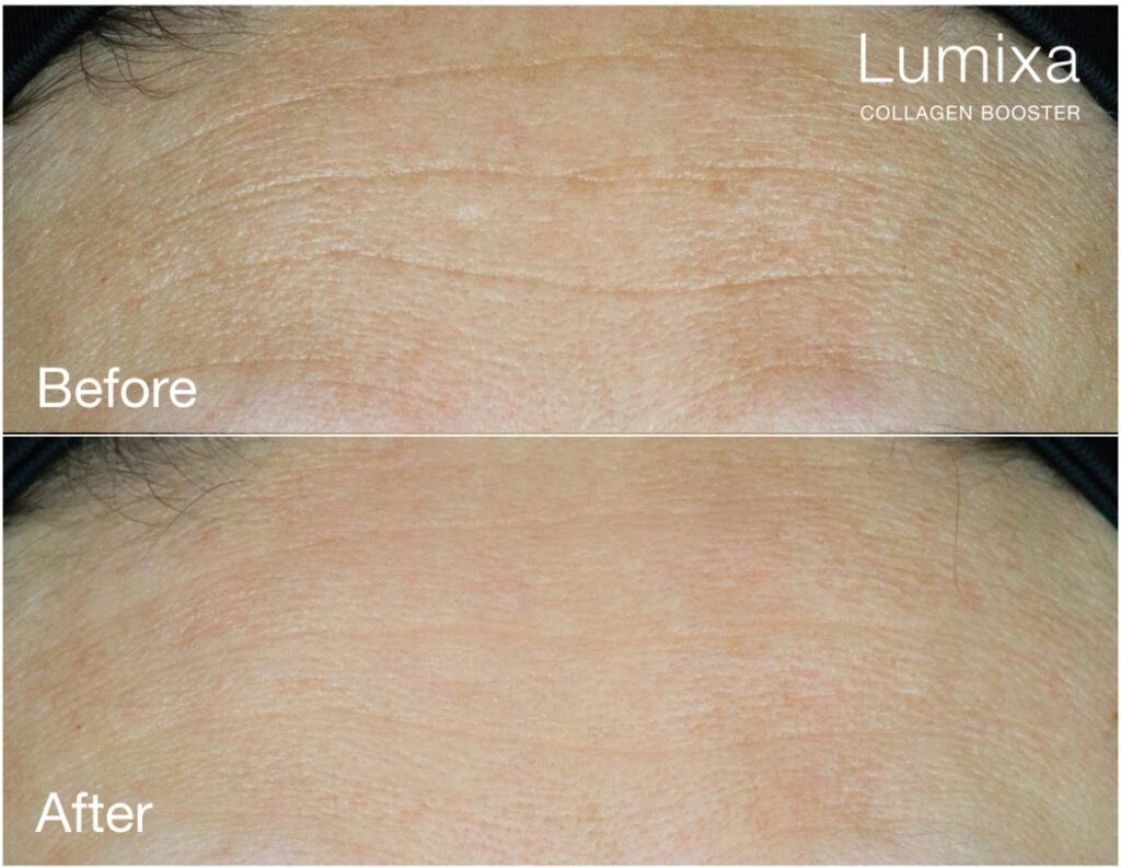 Lumixa Collagen Booster