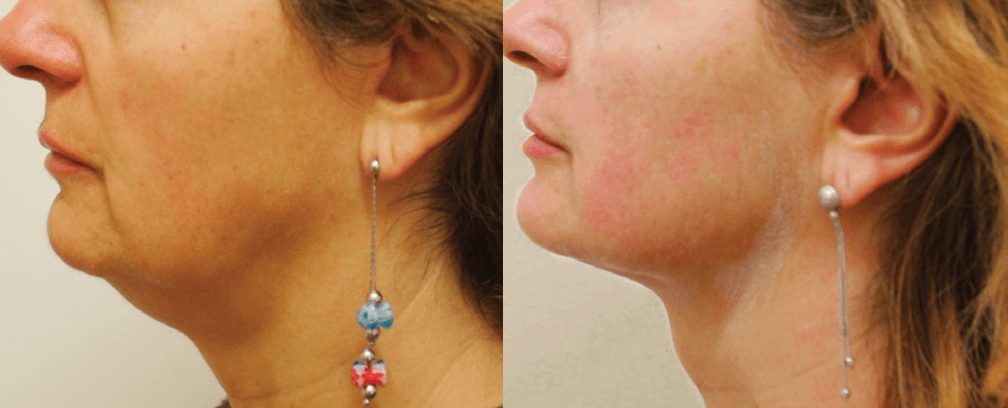 Ultraformer III Double Chin Results