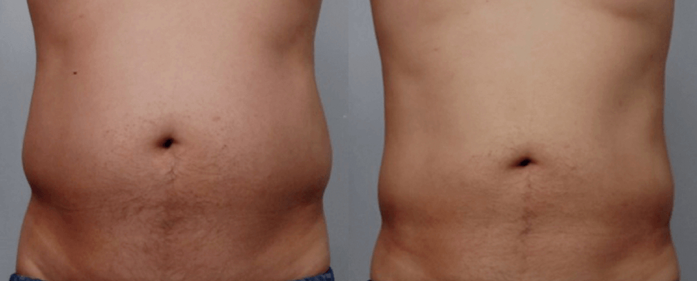 Ultraformer III Flanks Before & After