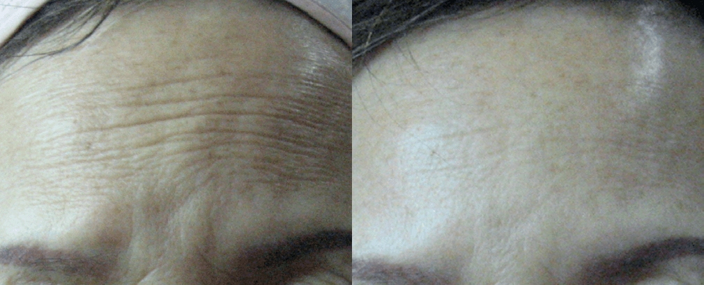 Ultraformer III Forehead Wrinkles Before & After