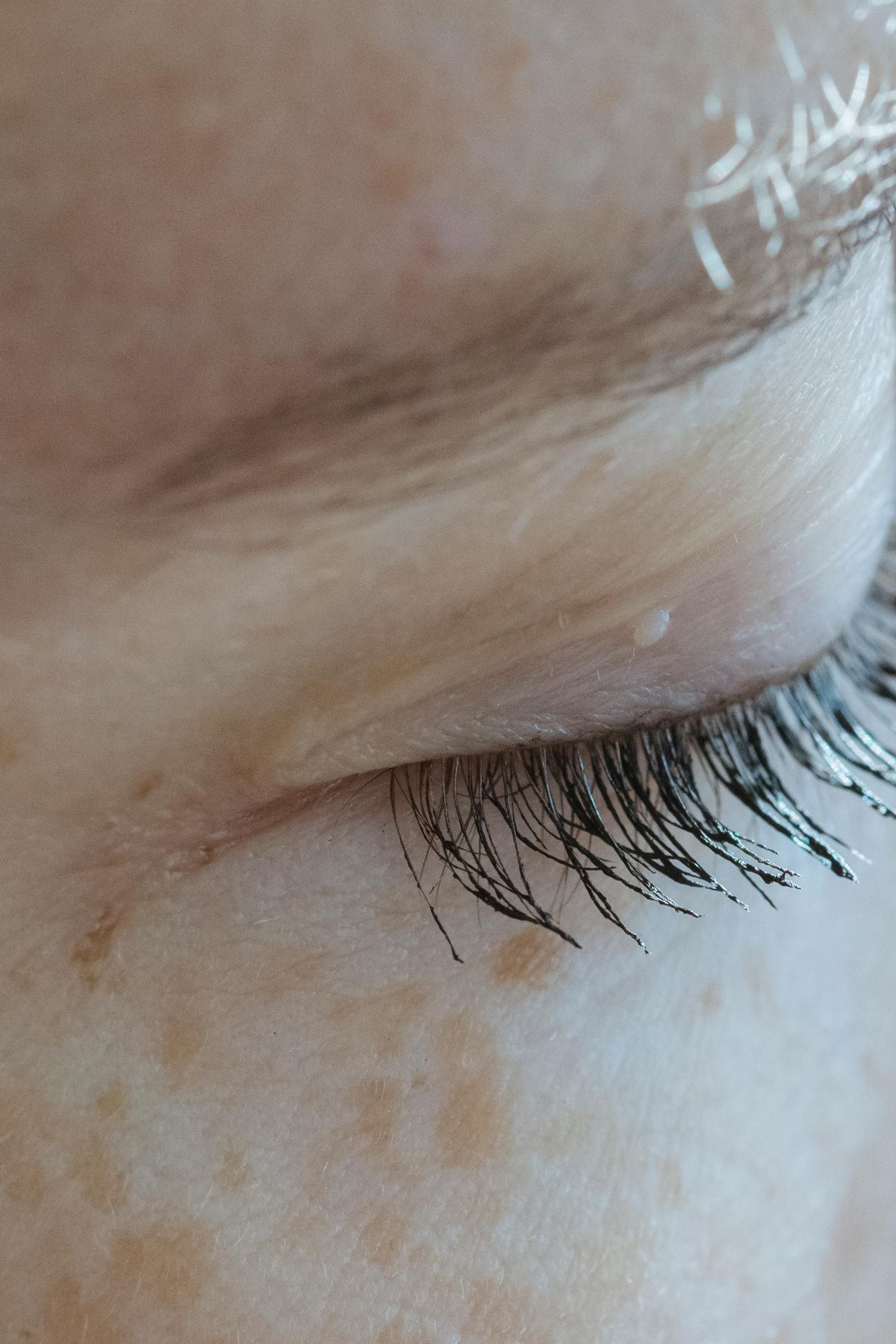 Milia On Eyelid