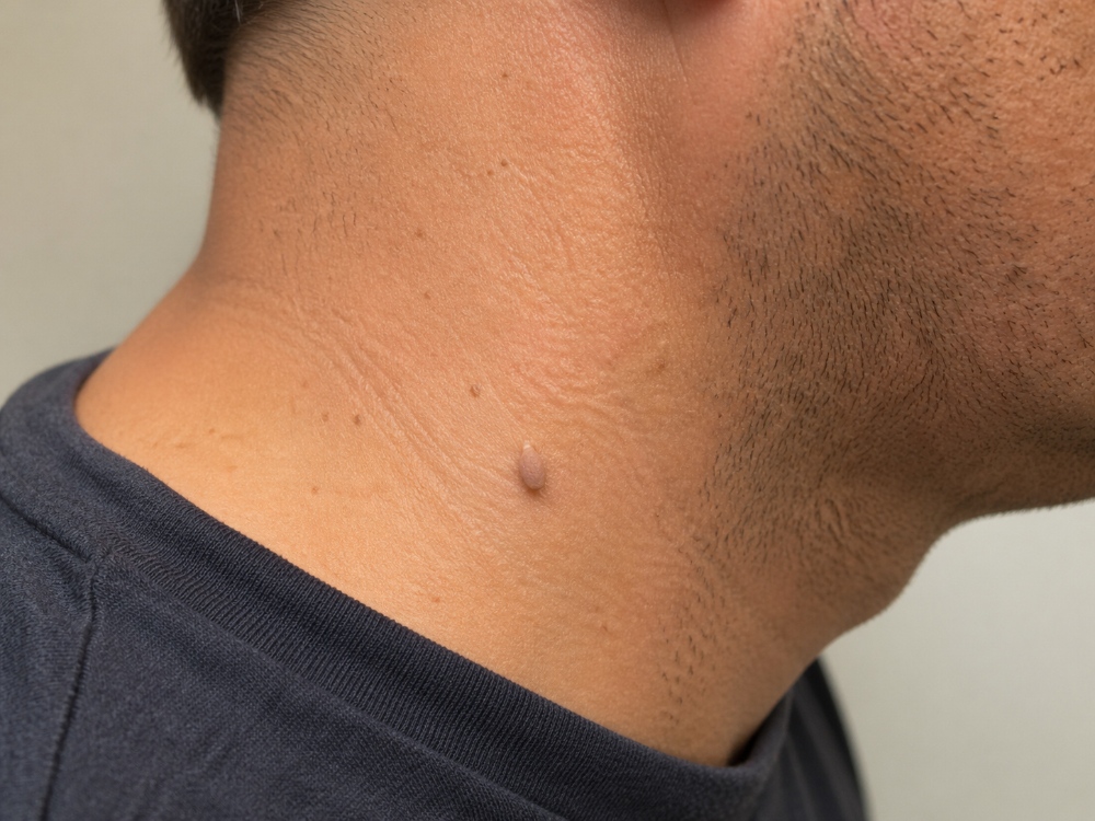 Skin Tag On A Man's Neck